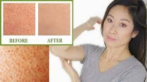 Understanding and Treating Keratosis Pilaris 2 Understanding and Treating Keratosis Pilaris