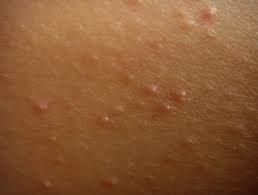 Understanding and Treating Keratosis Pilaris 3 keratosis pilaris treatment