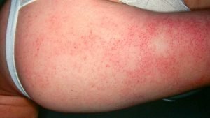 Understanding and Treating Keratosis Pilaris 4 keratosis pilaris treatment