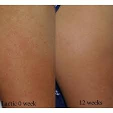Understanding and Treating Keratosis Pilaris 5 keratosis pilaris treatment