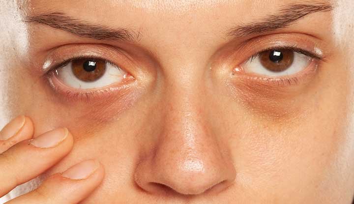 how to remove dark spots on eyes